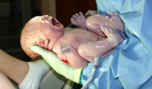 A newborn infant, seconds after delivery. Amniotic fluid glistens on the child's skin. - Photo: Wikimedia, Ernest F